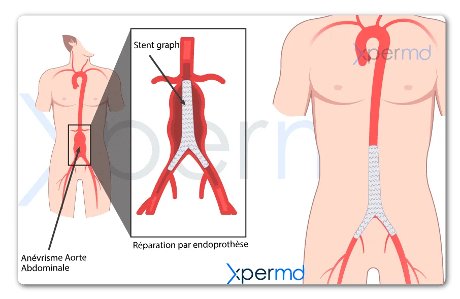 anevrisme aorte abdominale traitement