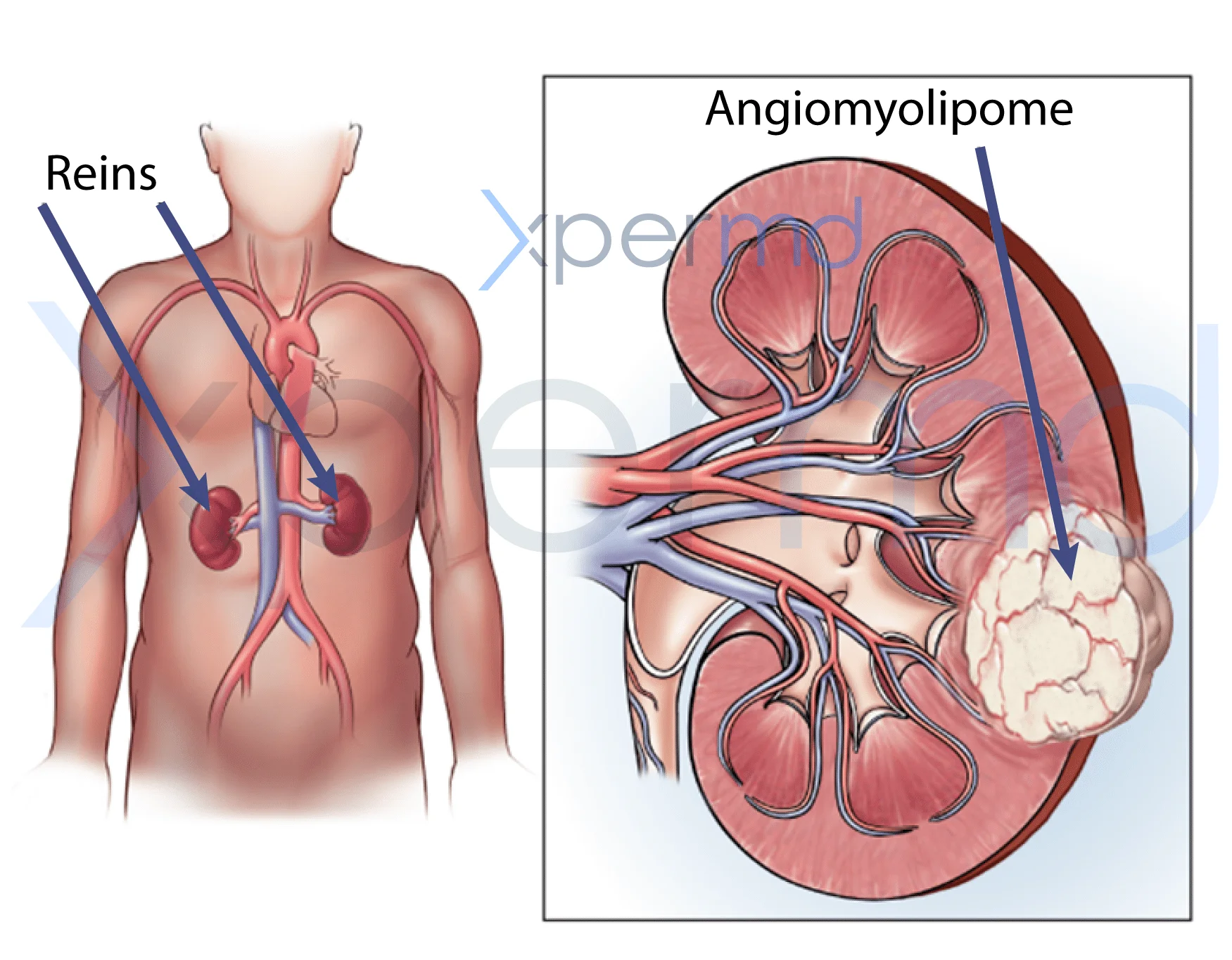 angiomyolipome xpermd 1
