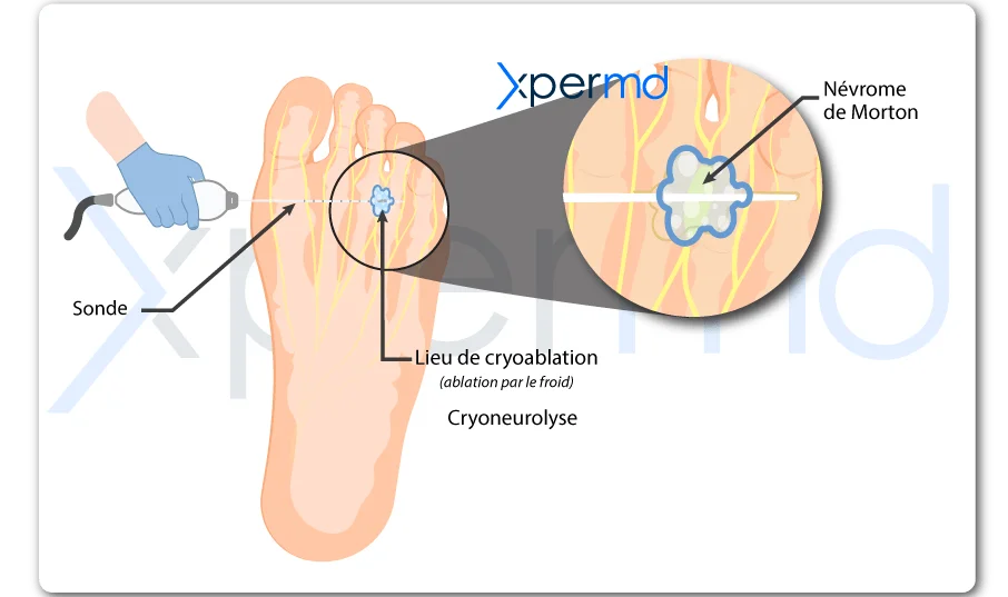 cryotherapie du nevrome de morton