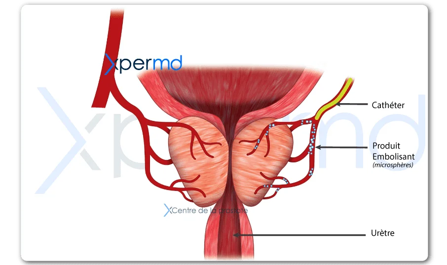 embolisation prostate traitement paris