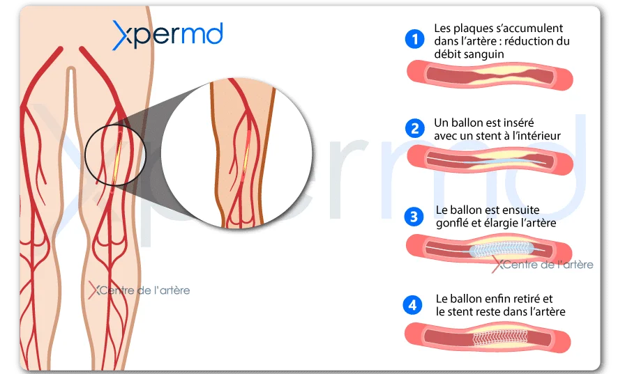 traitement arterite des membres inferieurs