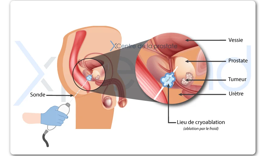 traitement cancer prostate paris