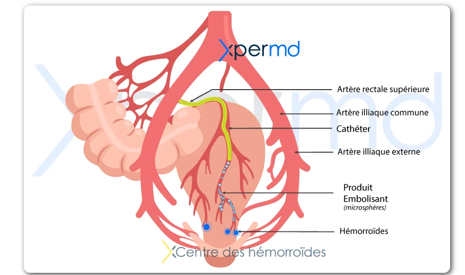 traitement hemorroides embolisation xpermd 