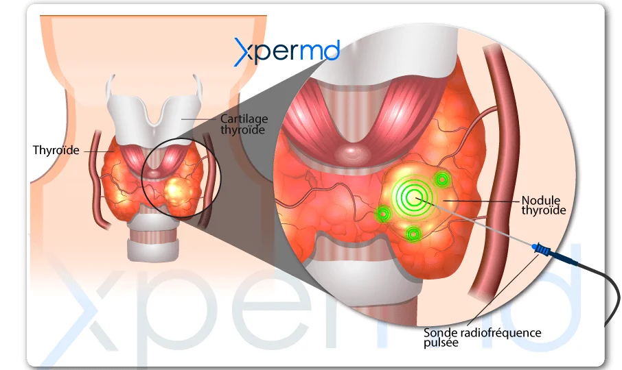 traitement nodule thyroide radiofrequence pulsee