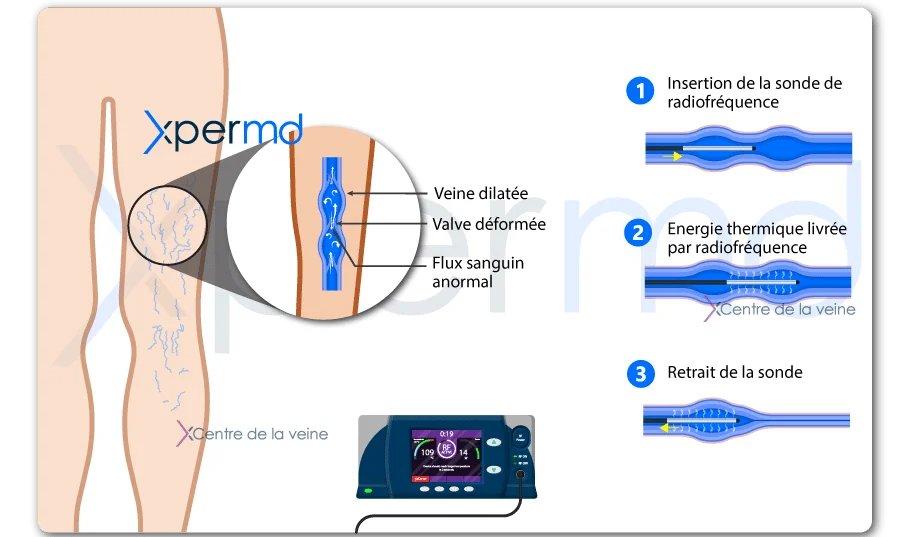 traitement varices jambes xpermd