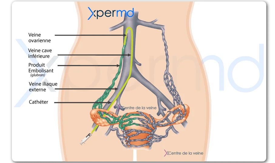 traitement varices pelviennes embolisation