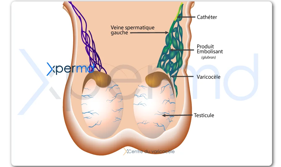 traitements varicocele xpermd