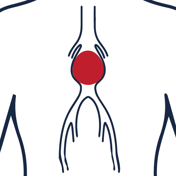 Anévrisme de l’aorte : Une prise en charge optimisée