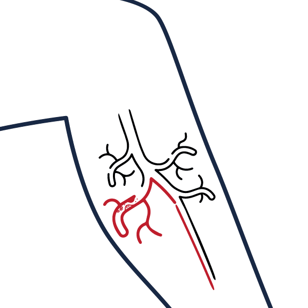 Artérite des membres inférieurs : Pathologie et traitement mini-invasif