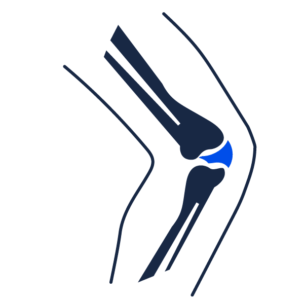 Arthrose du genou (Gonarthrose) : Les avancées médicales