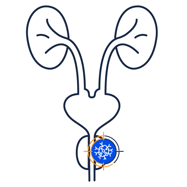 Prostatite chronique : Guide détaillé sur la condition médicale
