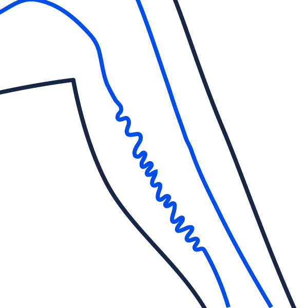 Varices des membres inférieurs